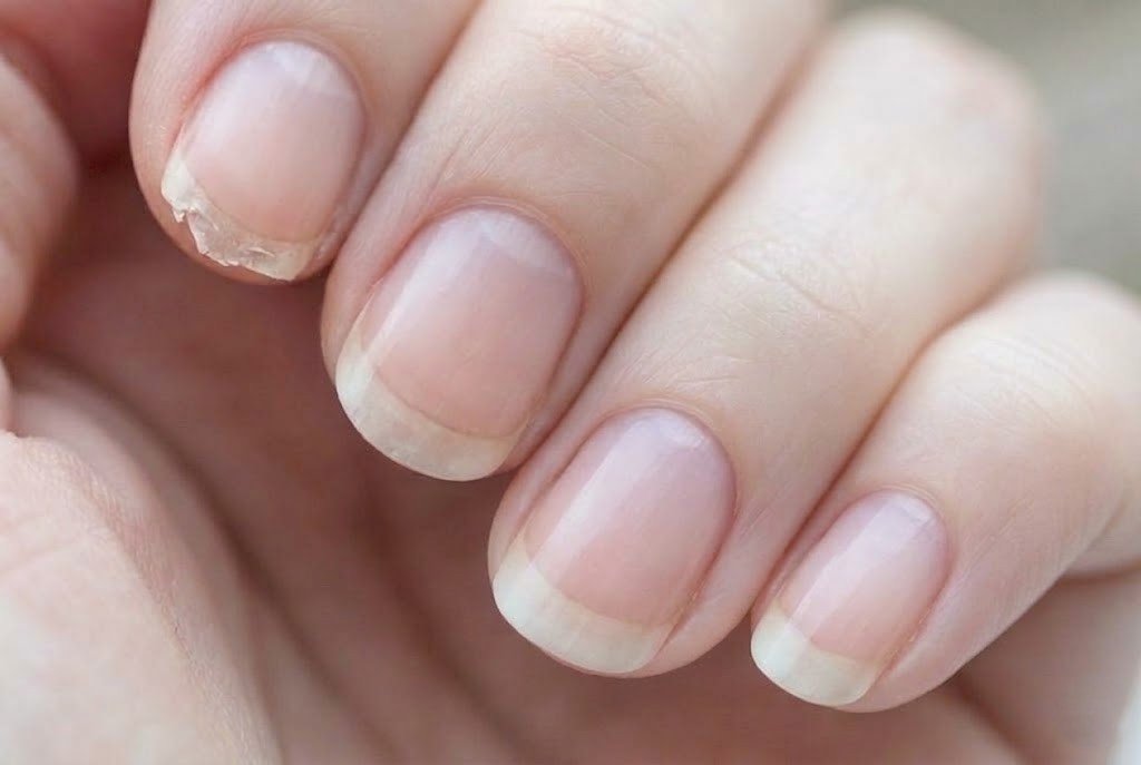lose-up of brittle nails with peeling nail plate and dry damaged skin around the nail fold