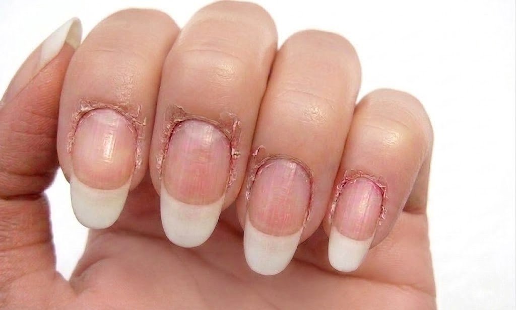 Damaged and torn cuticle skin around the nail fold showing the result of aggressive cutting or picking