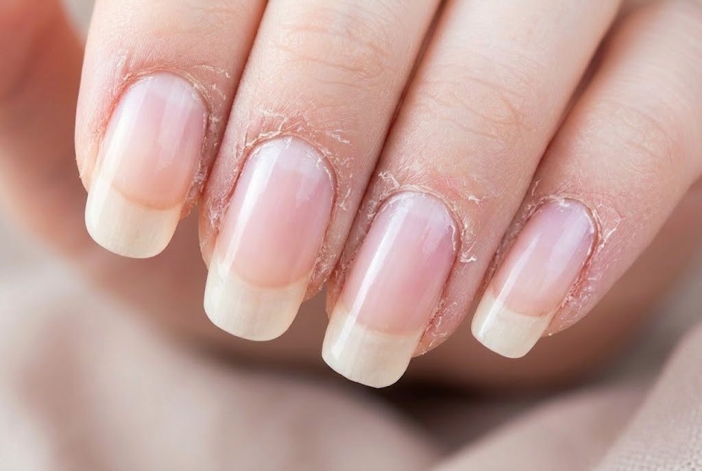 Severely dry and peeling cuticles with flaking skin around the nail fold showing signs of moisture loss