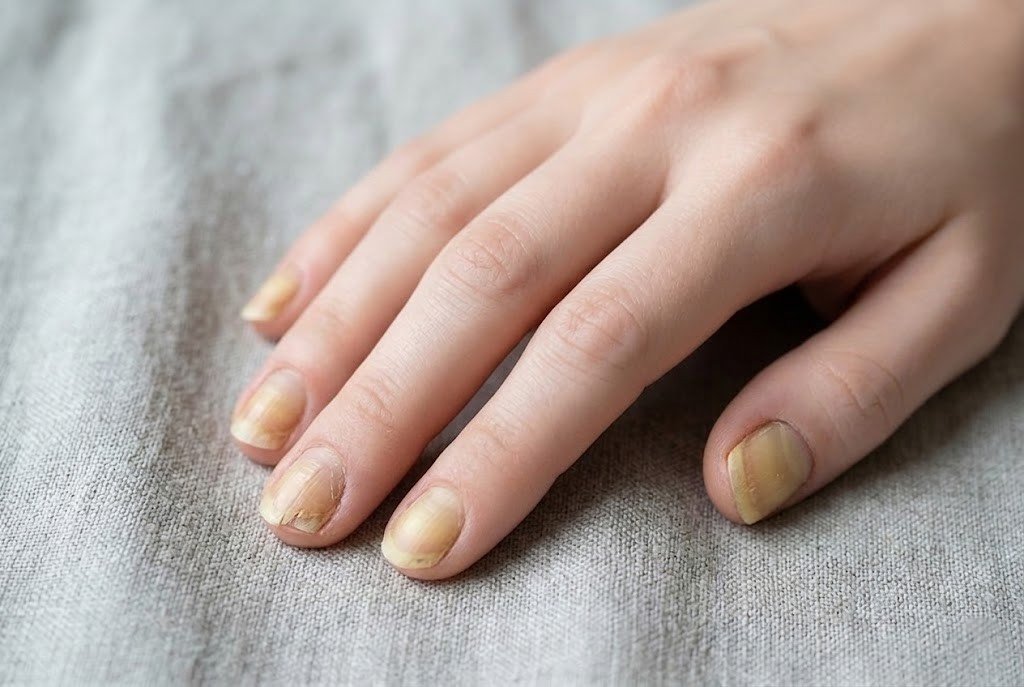 weak damaged nails before nail care routine